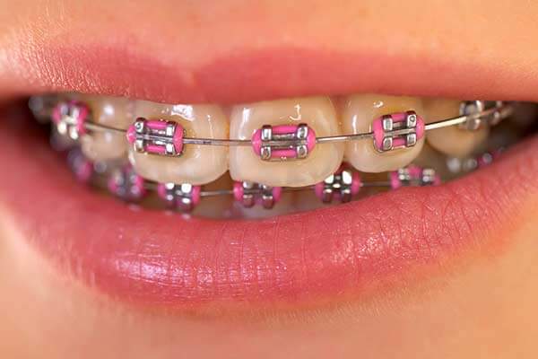 Metal Braces in Bridgewater, NJ