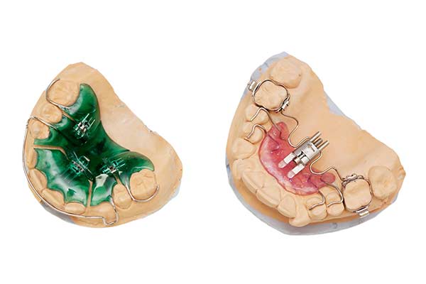 Palatal Expander Device (PED) in Bridgewater, NJ