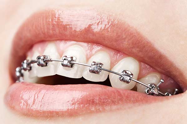 Self-Ligating Braces in Bridgewater, NJ