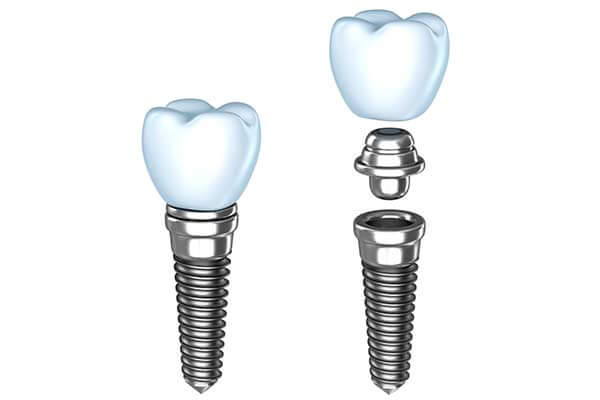 Single Dental Implants in Bridgewater, NJ