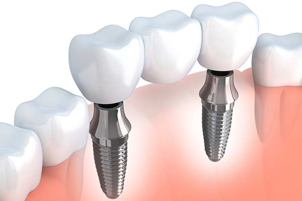 Dental Implants in Bridgewater, NJ